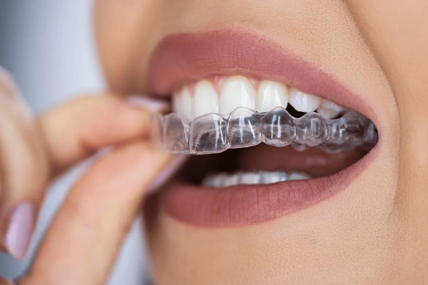 Invisalign / átlátszó fogszabályozó