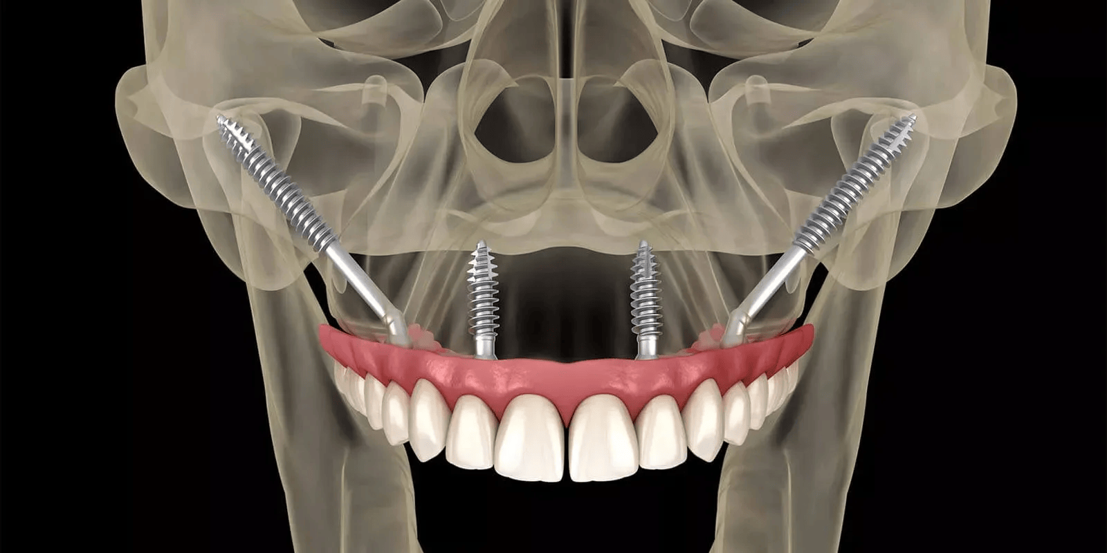 Zigomatikus implantátumok